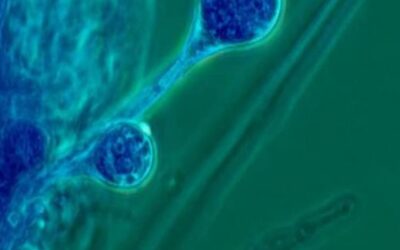 म्युकॉर मायकोसीस (mucormycosis)आणि करोना एक अभद्र युती