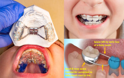 इंटरसेप्टिव  ऑर्थोडॉण्टिक्स