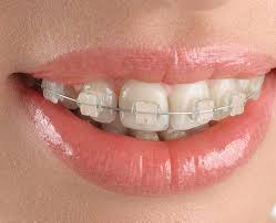 Orthodontic ट्रीटमेंटची कमाल